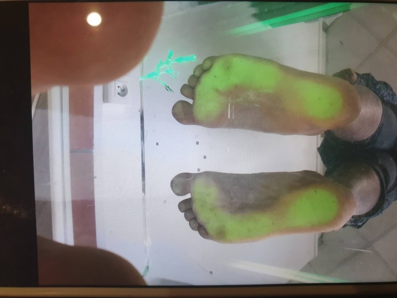 Procédé de fabrication d'une  une orthèse du pied droit sur mesure sur Paris 13 et proche du Kremlin-Bicêtre